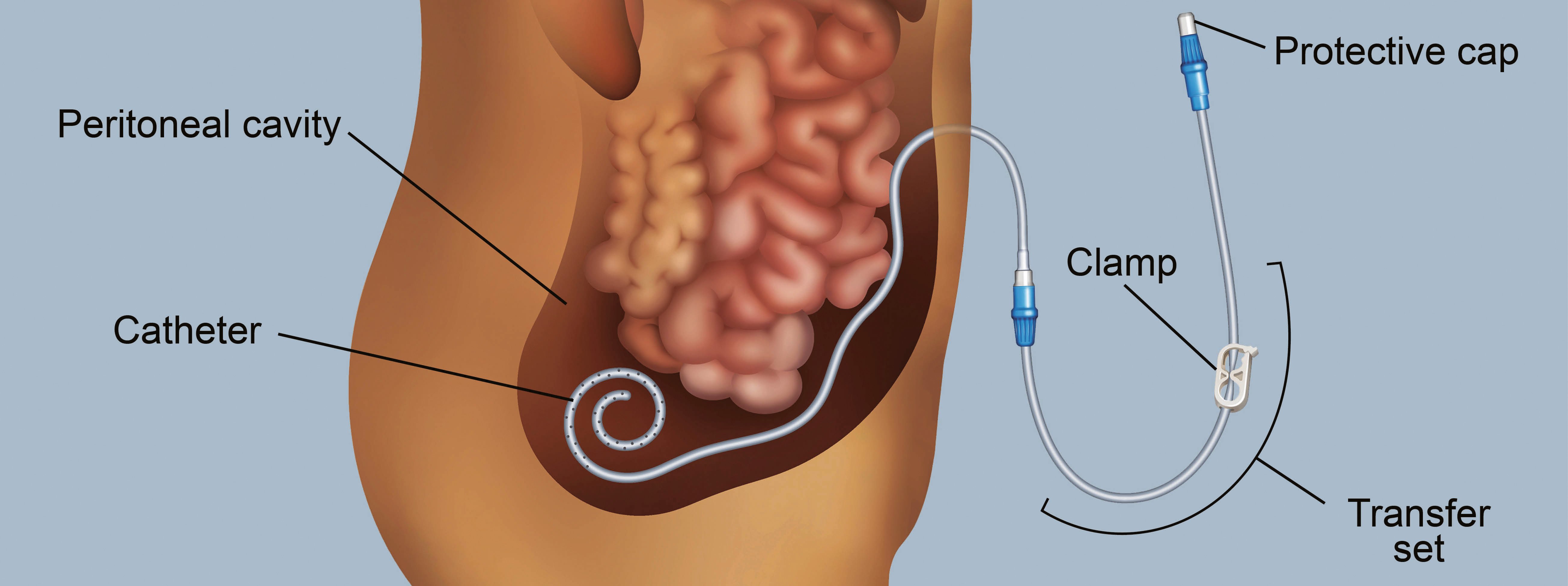 Peritoneal dialysis catheter