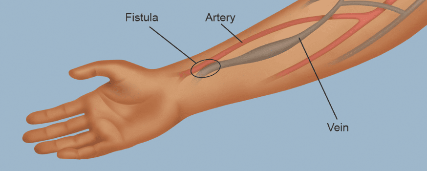 Arteriovenous (AV) fistula